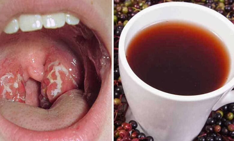 Boğaz Ağrısını 4 Saatte Geçiren Basit ve Etkili Yöntem 1 11 Home Remedies to Treat Strep Throat Boğaz Ağrısını 4 Saatte Geçiren Basit ve Etkili Yöntem