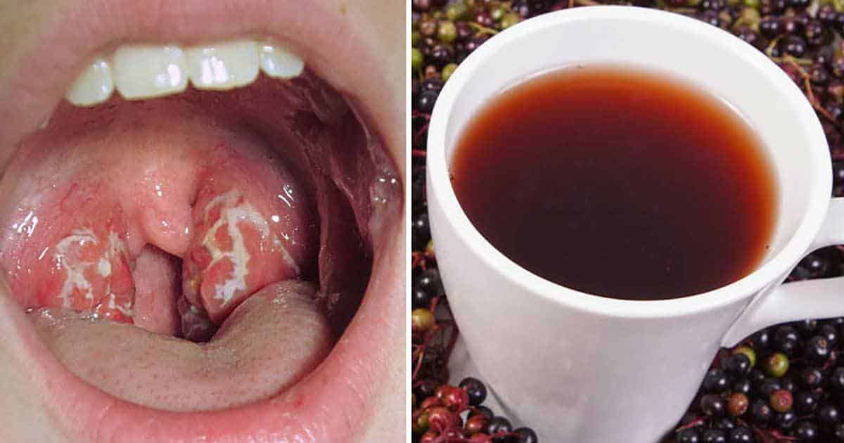 11 Home Remedies to Treat Strep Throat Boğaz Ağrısını 4 Saatte Geçiren Basit ve Etkili Yöntem