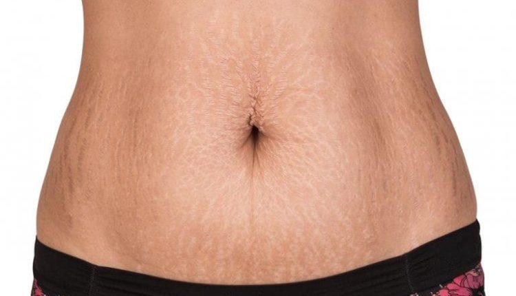Doğum Çatlakları Nasıl Geçer? Ne İyi Gelir? Bitkisel Çözüm