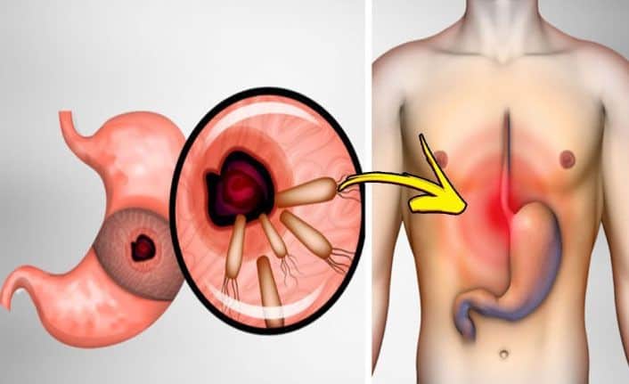 Helicobacter Pylori Nedir Mide Mikrobunun Doğal Tedavileri