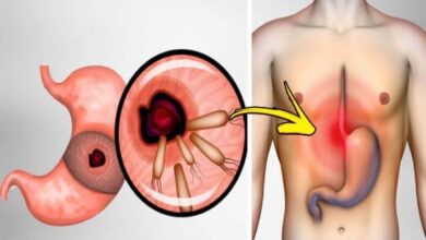 Helicobacter Pylori Nedir Mide Mikrobunun Doğal Tedavileri