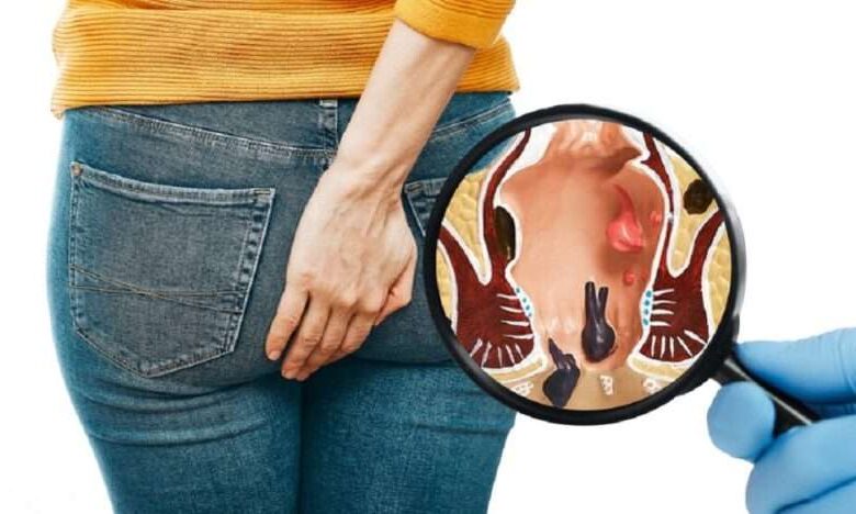 Basur (hemoroid) için inanılmaz çözüm!