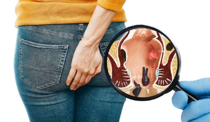 Basur (hemoroid) için inanılmaz çözüm!