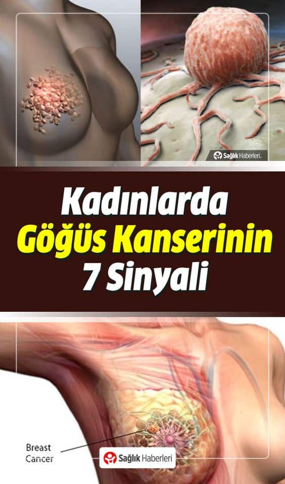 Meme Kanserinin En Belirgin 5 Belirtisi