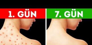 Beslenme alışkanlıklarınızı değiştirerek cilt sorunlarından kurtulun