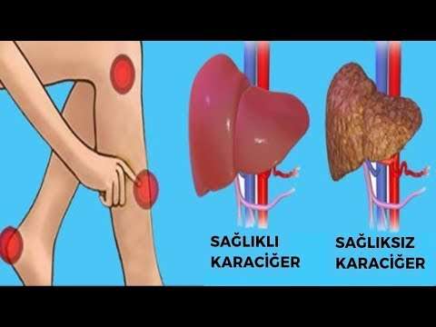 Bu 6 uyarı karaciğerinizin toksinlerle dolu olduğunu gösteriyor.