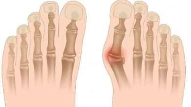 Bunyon ağrısı nasıl geçer?