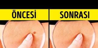 Doğal olarak et benlerinden kurtulmak için 10 etkili yöntem