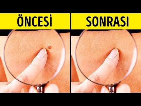 Doğal olarak et benlerinden kurtulmak için 10 etkili yöntem