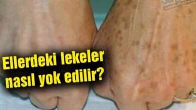 Ellerdeki lekeler nasıl yok edilir?