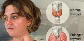 Guatr nedir? Guatrın belirtileri ve tedavi yöntemleri nelerdir?