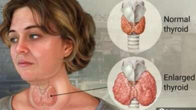 Guatr nedir? Guatrın belirtileri ve tedavi yöntemleri nelerdir?