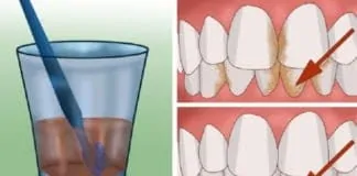 Diş Tartarı Nasıl Yok Edilir? Doğal Çözüm! Evde