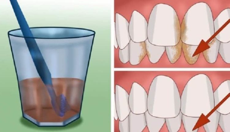 Diş Tartarı Nasıl Yok Edilir? Doğal Çözüm Ne! Evde Tartar Temizleme