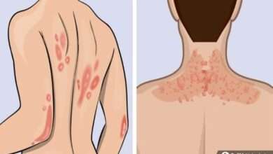 Sedef hastalığı belirtileri, nedenleri ve tedavisi