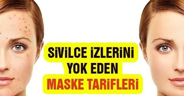 Sivilce ve izleri yok eden maske tarifi 1 Sivilce ve izleri yok eden maske tarifi