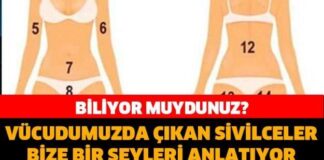 Vücudumuzda çıkan sivilceler bize neyi anlatıyor?