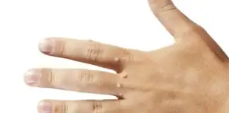 Siğilleri Doğal Yollardan Yok Eden Formül
