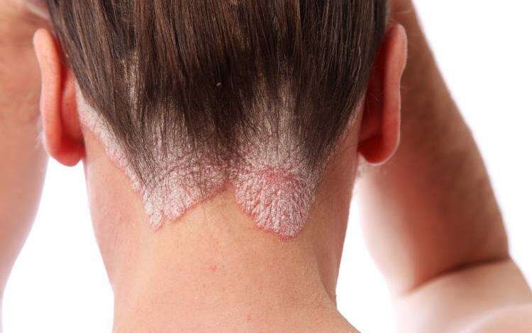 tipoi psoriasis symptomata Saçtaki kaşıntılı egzama nasıl geçer, ne iyi gelir?