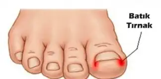 Tırnak Batması İçin Doğal Tedaviler