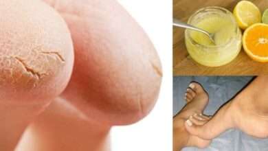 Topuk çatlağı neden oluşur? Topuk çatlağı nasıl tedavi edilir?