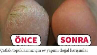 Topuk Çatlaklarına Doğal Çözüm İçin 3 Yöntem