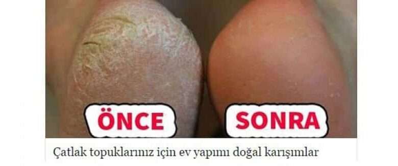 Topuk Çatlaklarına Doğal Çözüm İçin 3 Yöntem
