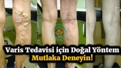 Varis tedavisinde mucizevi doğal yöntem
