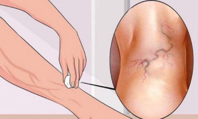 Varisleri yok eden doğal yöntemler!