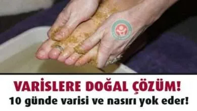 Varisli damarları yok eden doğal yöntem 3 Varisli damarları yok eden doğal yöntem