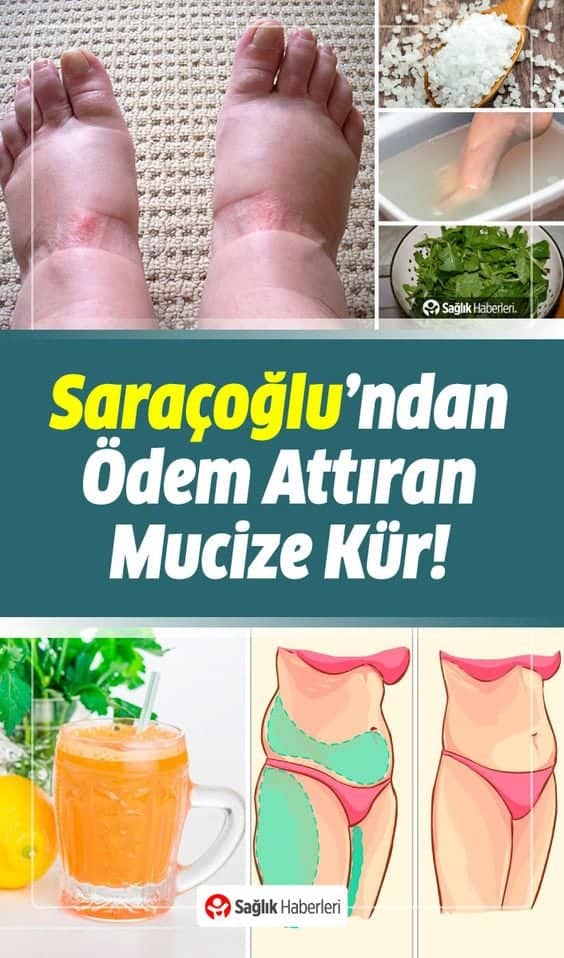 Ödem neden olur? Belirtileri nelerdir? Nasıl atılır? Saraçoğlu ödem kürü