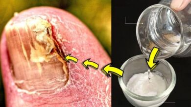 Ayak Tırnağı Mantarı Doğal Tedavisi Nasıl Yapılır Ne İyi Gelir