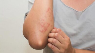 Cilt (Deri) Hastalıkları Çeşitleri Nelerdir? Belirtileri ve Bitkisel Tedavileri