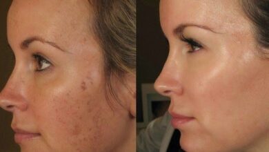 Dermapen Nedir? Ne Zaman Nasıl Yapılır? Dermapenin Faydaları Nelerdir?