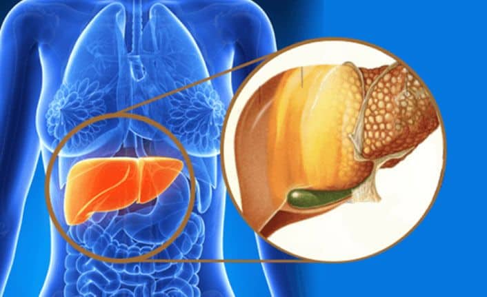 Karaciğer Yağlanması Nedir? Karaciğer Yağlanmasına İyi Gelen 7 Yiyecek