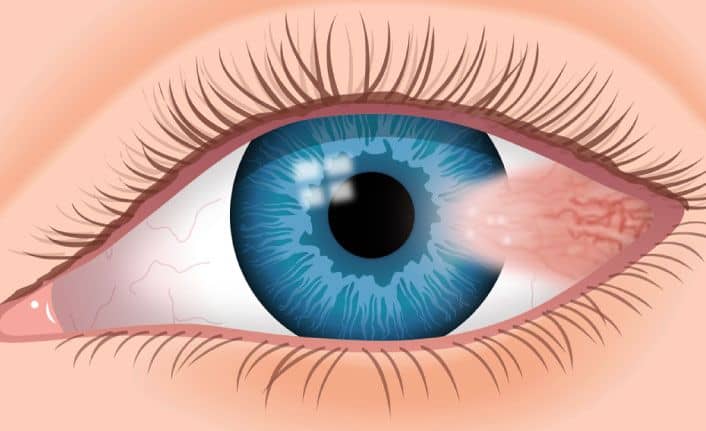 Gözde Pterygium - Pterjium( Kuşkanadı Hastalığı Veya Gözde Et Yürümesi) Nedir?