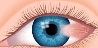 Gözde Pterygium - Pterjium( Kuşkanadı Hastalığı Veya Gözde Et Yürümesi) Nedir?