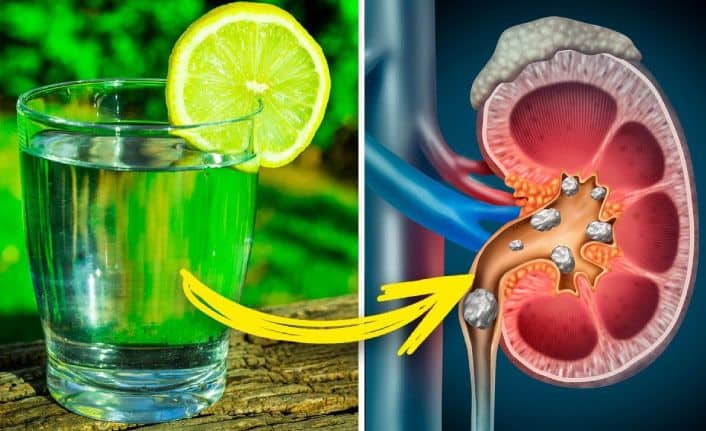 Limon Suyu Faydaları Nelerdir Limon Suyu ile Tedavi Edebileceğiniz 8 Sağlık Problemi