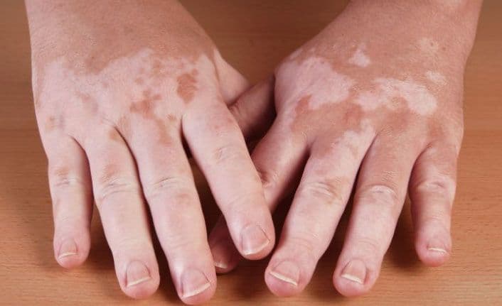 Addison Hastalığı Nedir Belirtileri, Nedenleri ve Tedavi Yöntemleri Nelerdir