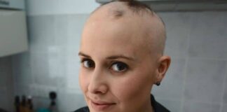 Alopesi Saç Dökülmesi Nedir Belirtileri, Nedenleri ve Tedavisi