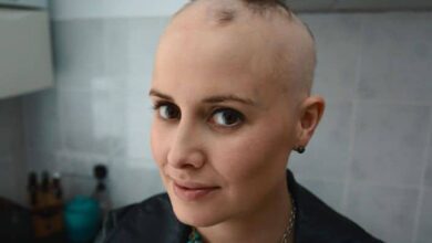 Alopesi Saç Dökülmesi Nedir Belirtileri, Nedenleri ve Tedavisi