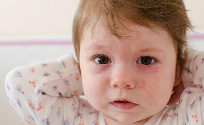 Altıncı Hastalık Nedir Belirtileri ve Tedavi Yöntemleri Nelerdir