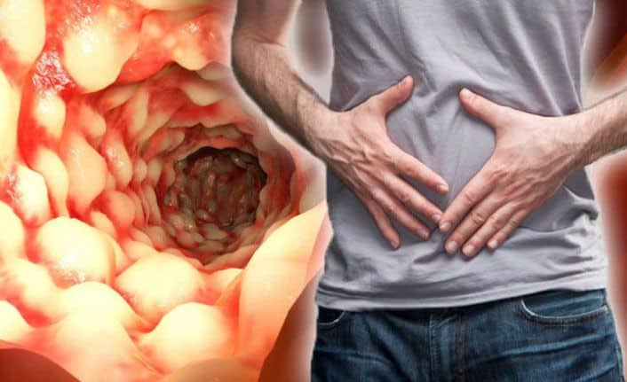 Chron Hastalığı Nedir Belirtileri, Nedenleri ve Tedavi Yöntemleri