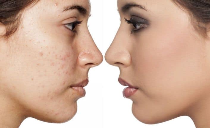 Kışın Sivilceler Neden Artar Kışın Cilt Sağlığı İçin Ne Yapılmalı