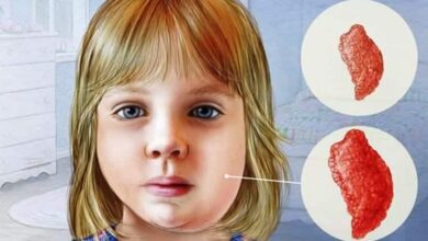 662625b0690570de6ff0ce815fdffba5 Kabakulak Nedir? Nasıl Bulaşır? Kabakulak Hastalığına Ne İyi Gelir?