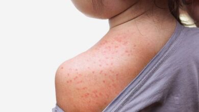 Heat Rashes In Chidren İsilik Nedir, Neden Olur? Belirtileri ve Korunma Yolları Nelerdir? Tedavisi