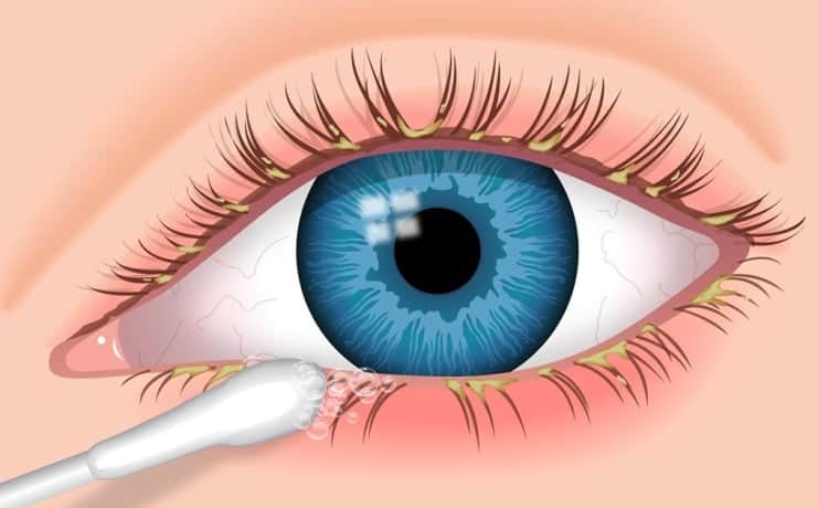 blepharitis eye swab Kirpik Dibi İltihabı Neden Olur? Korunma Yolları Nelerdir?