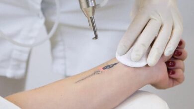 how does laser tattoo removal work Lazerle Dövme Silme İşlemi Nasıl Yapılır? Kaç Seans Sürer?