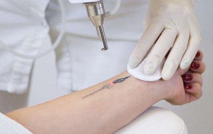 Lazerle Dövme Silme İşlemi Nasıl Yapılır? Kaç Seans Sürer? 1 how does laser tattoo removal work Lazerle Dövme Silme İşlemi Nasıl Yapılır? Kaç Seans Sürer?