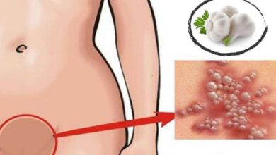 saglikhaberleri 2018 Recovered 3 Genital Siğil (Kondilom) Nedir? Belirtileri, Nedenleri ve Tedavi Yöntemleri